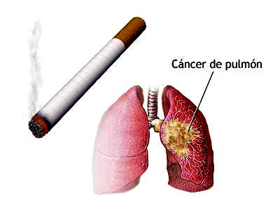 cancer-pulmon.jpg