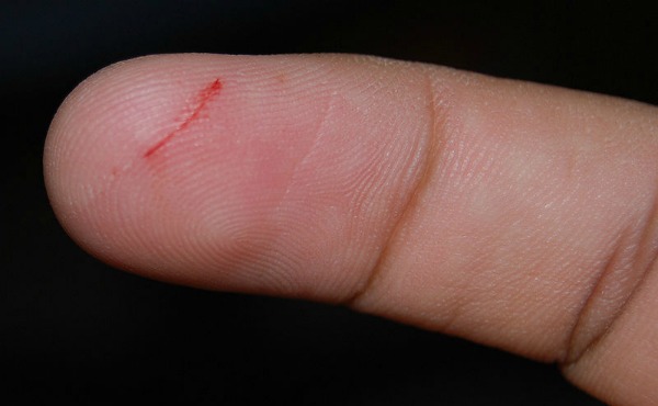 corte+dedo.jpg
