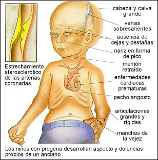progeria_eskema.jpg